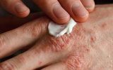 تغییر فصل، محرک اگزما نه عامل ایجاد آن تغییر فصل، محرک اگزما نه عامل ایجاد آن